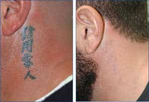 tatueringsborttagning